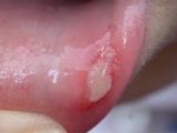 Tongue Ulcer 